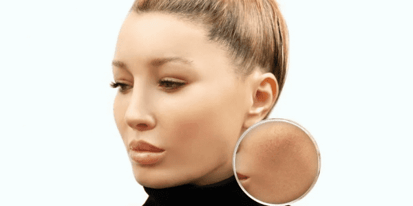 Güneşin Yan Etkileri: Melazma Hakkında Bilmeniz Gerekenler