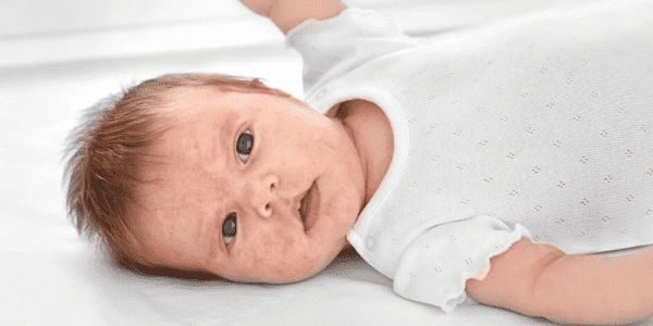 Yenidoğan Bebek Alerji Belirtileri Hakkında Yapılabilecekler