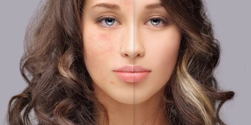 Gözenek Karşıtı Bakım Rehberi: Pürüzsüz Bir Cilde Kavuşun